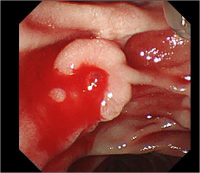 Case report: Endoscopic Hemoclip treatment for massive hematemesis caused by a Dieulafoy’s lesion on duodenal papilla caused acute pancreatitis